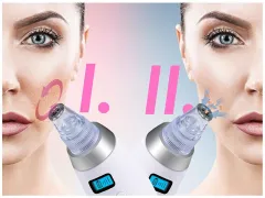 BeautyRelax Cosmetic device for skin abrasion Peelmax thumbnail 4